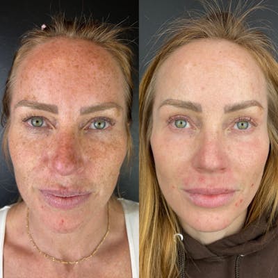 Laser Resurfacing Before & After Gallery - Patient 376559 - Image 1
