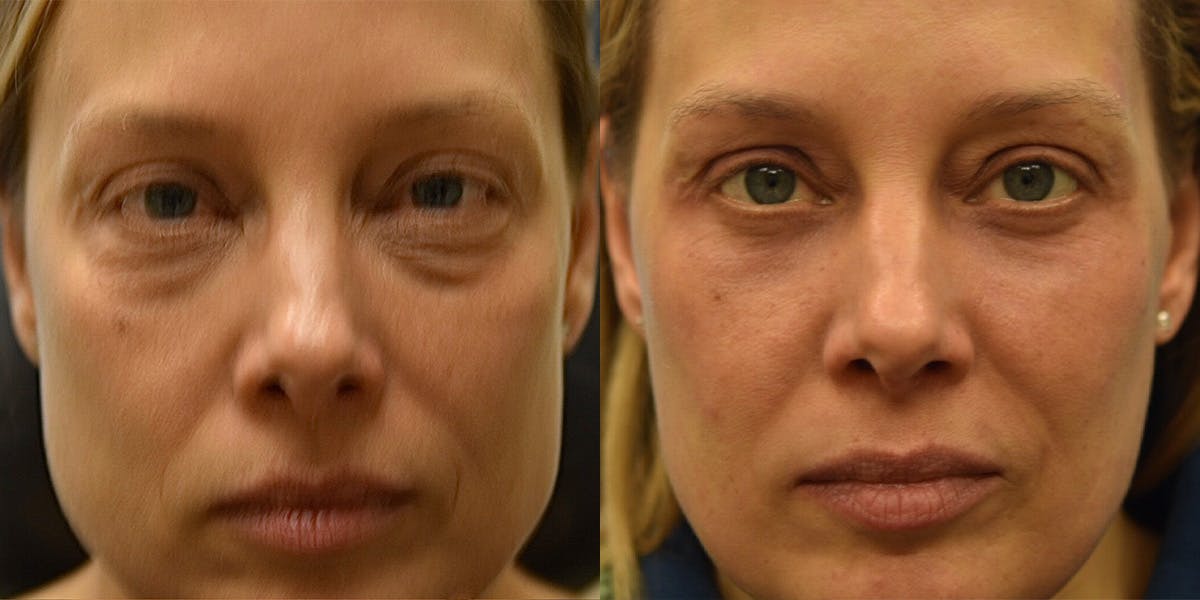 Laser Resurfacing Before & After Gallery - Patient 315726 - Image 1