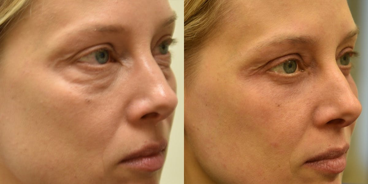 Laser Resurfacing Before & After Gallery - Patient 315726 - Image 2