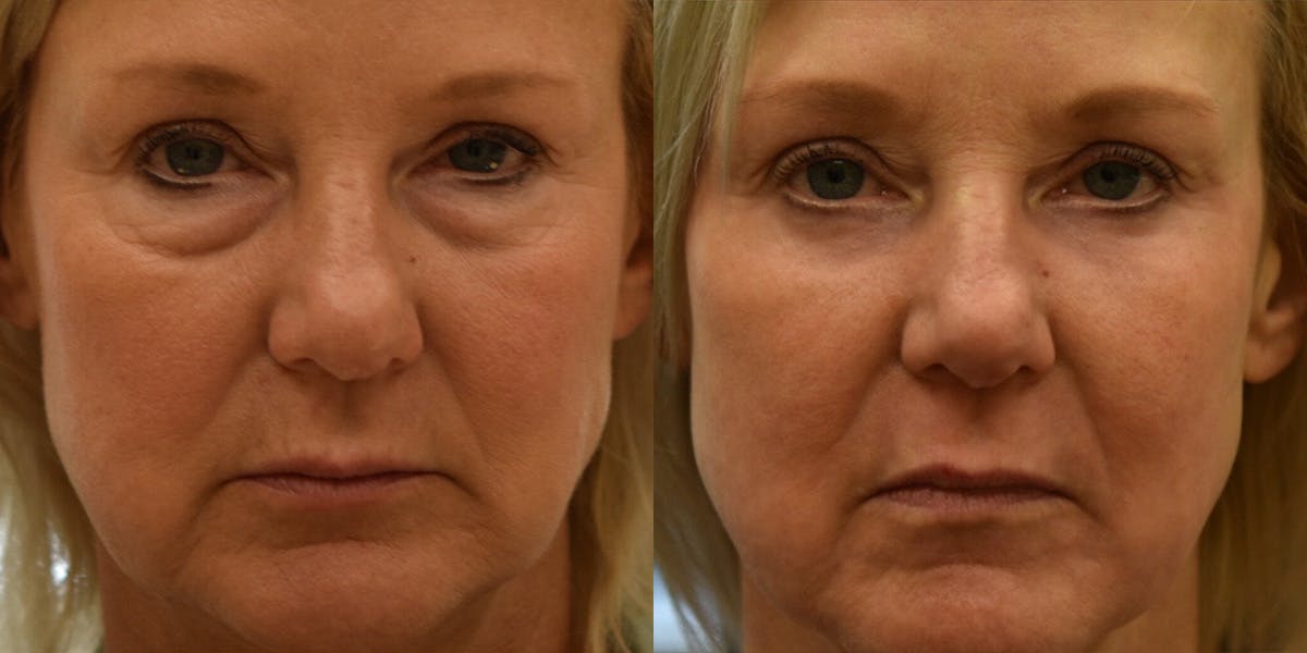 Laser Resurfacing Before & After Gallery - Patient 228549 - Image 1