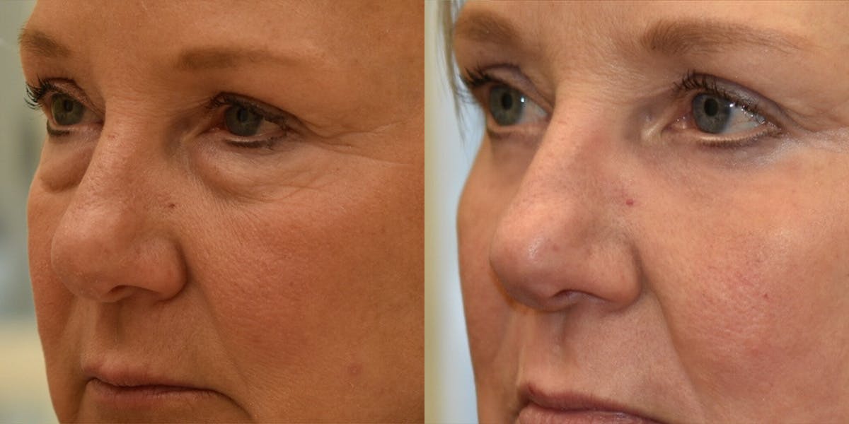 Laser Resurfacing Before & After Gallery - Patient 228549 - Image 3