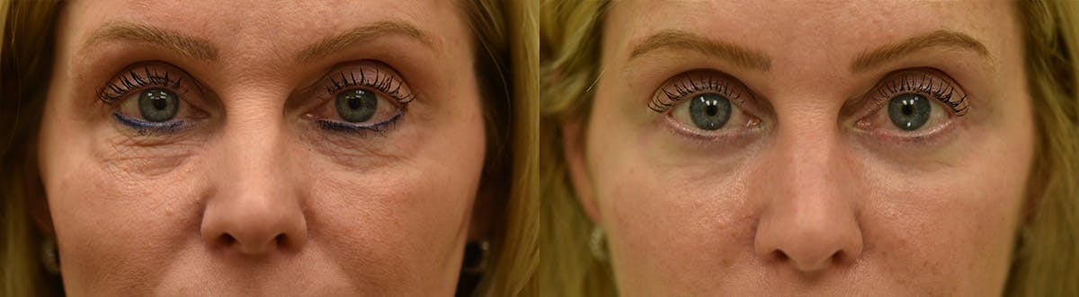 Laser Resurfacing Before & After Gallery - Patient 829087 - Image 1