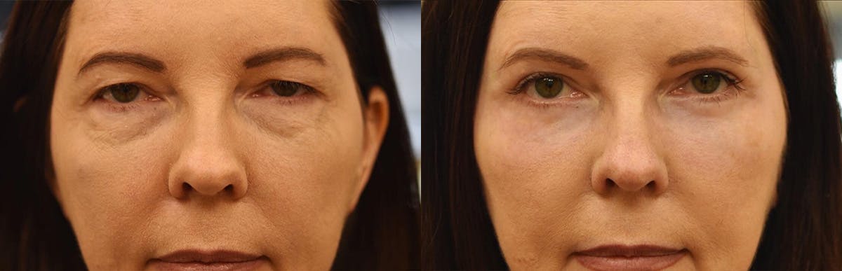 Laser Resurfacing Before & After Gallery - Patient 425746 - Image 1