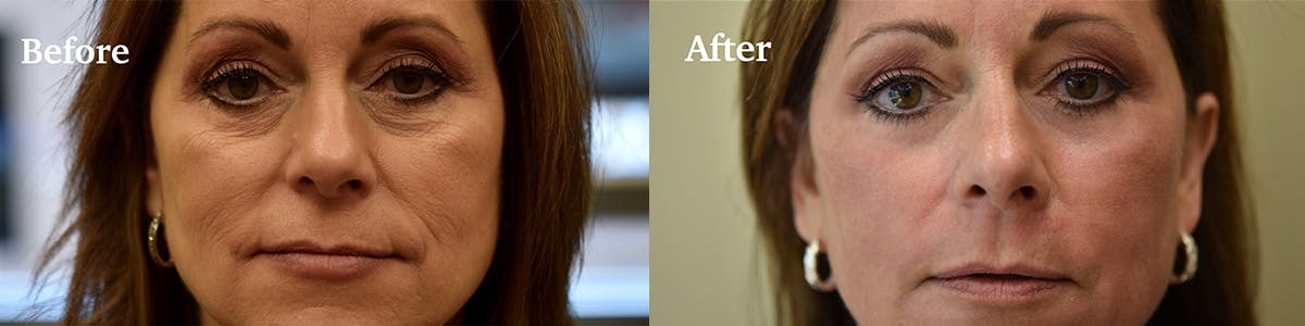 Laser Resurfacing Before & After Gallery - Patient 101430 - Image 1
