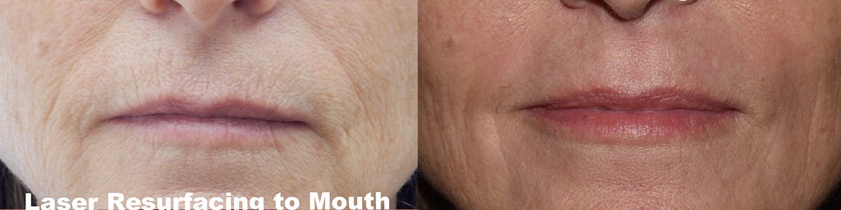 Laser Resurfacing Before & After Gallery - Patient 270563 - Image 1