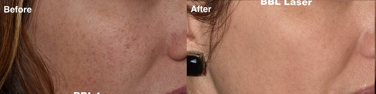 Laser Resurfacing Before & After Gallery - Patient 985587 - Image 1