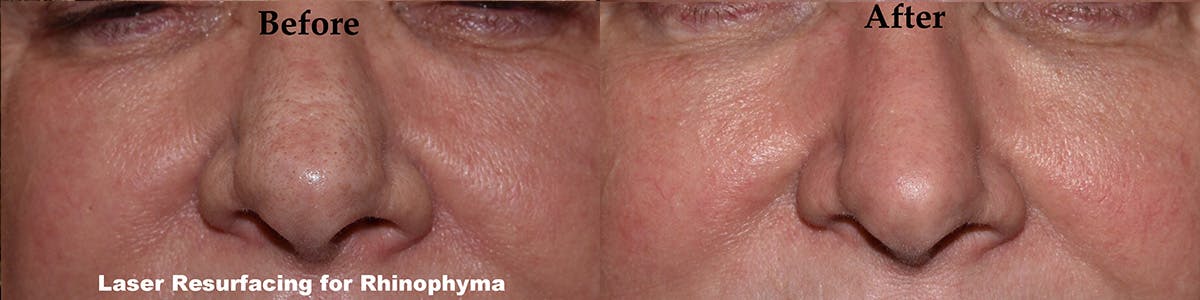 Laser Resurfacing Before & After Gallery - Patient 209625 - Image 1