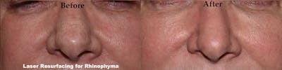 Laser Resurfacing Before & After Gallery - Patient 209625 - Image 1