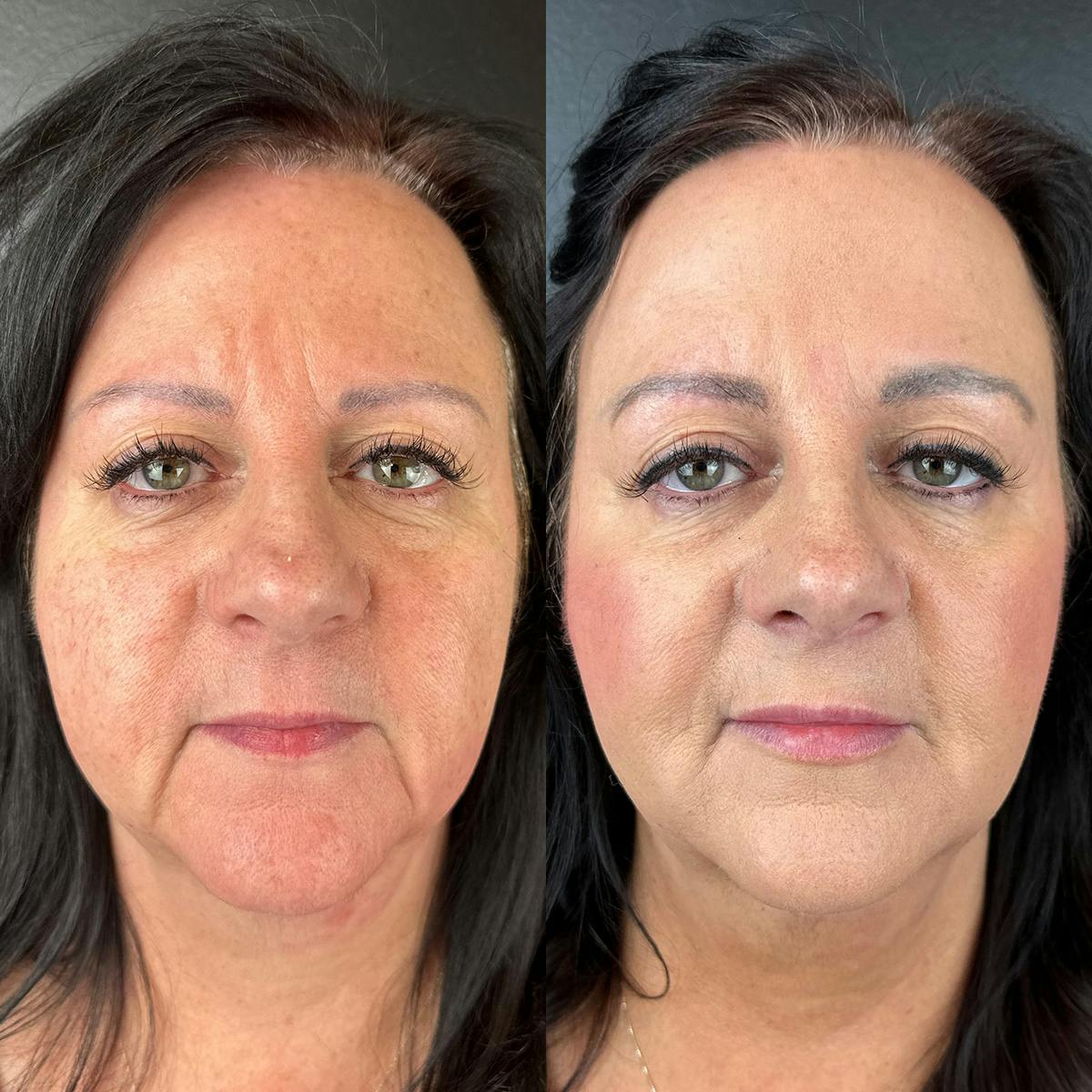 Lower Face Filler Before & After Gallery - Patient 317946 - Image 2