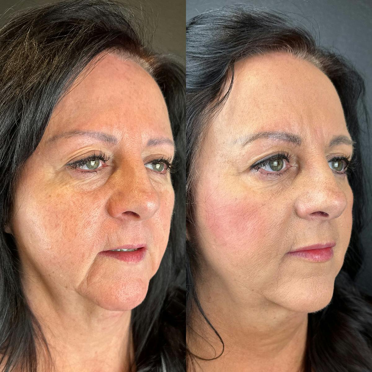 Lower Face Filler Before & After Gallery - Patient 317946 - Image 1