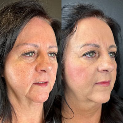Lower Face Filler Before & After Gallery - Patient 317946 - Image 1