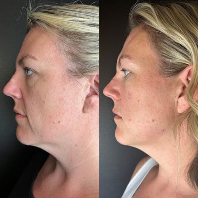 Lower Face Filler Before & After Gallery - Patient 370798 - Image 1