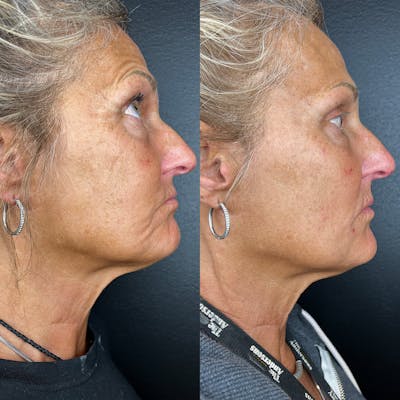 Lower Face Filler Before & After Gallery - Patient 877671 - Image 1