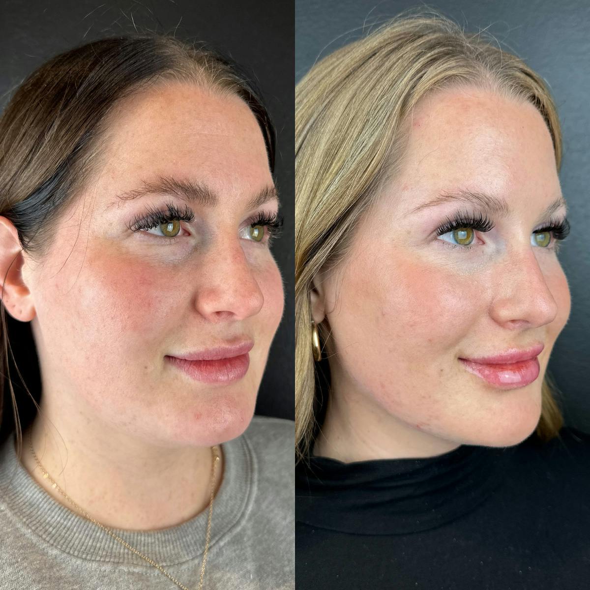 Lower Face Filler Before & After Gallery - Patient 104210 - Image 1