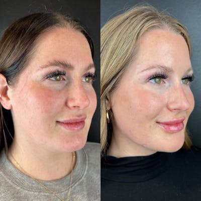 Lower Face Filler Before & After Gallery - Patient 104210 - Image 1