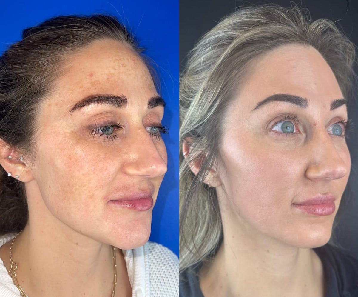 IPL Before & After Gallery - Patient 195988 - Image 2
