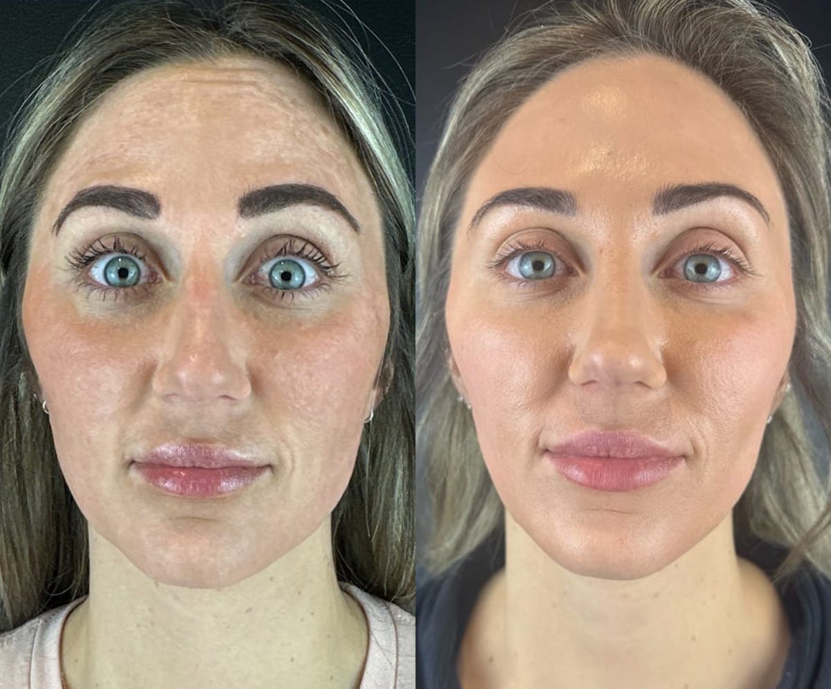 IPL Before & After Gallery - Patient 195988 - Image 1