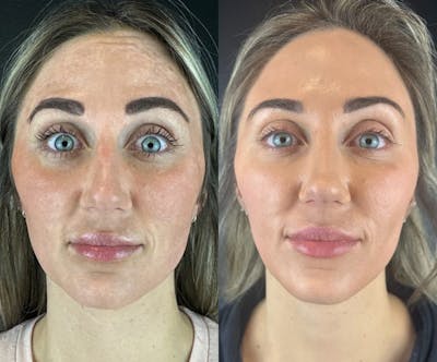 IPL Before & After Gallery - Patient 195988 - Image 1