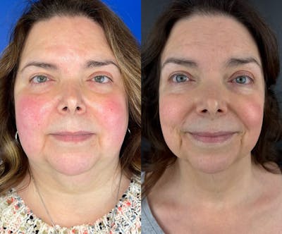 IPL Before & After Gallery - Patient 323824 - Image 1