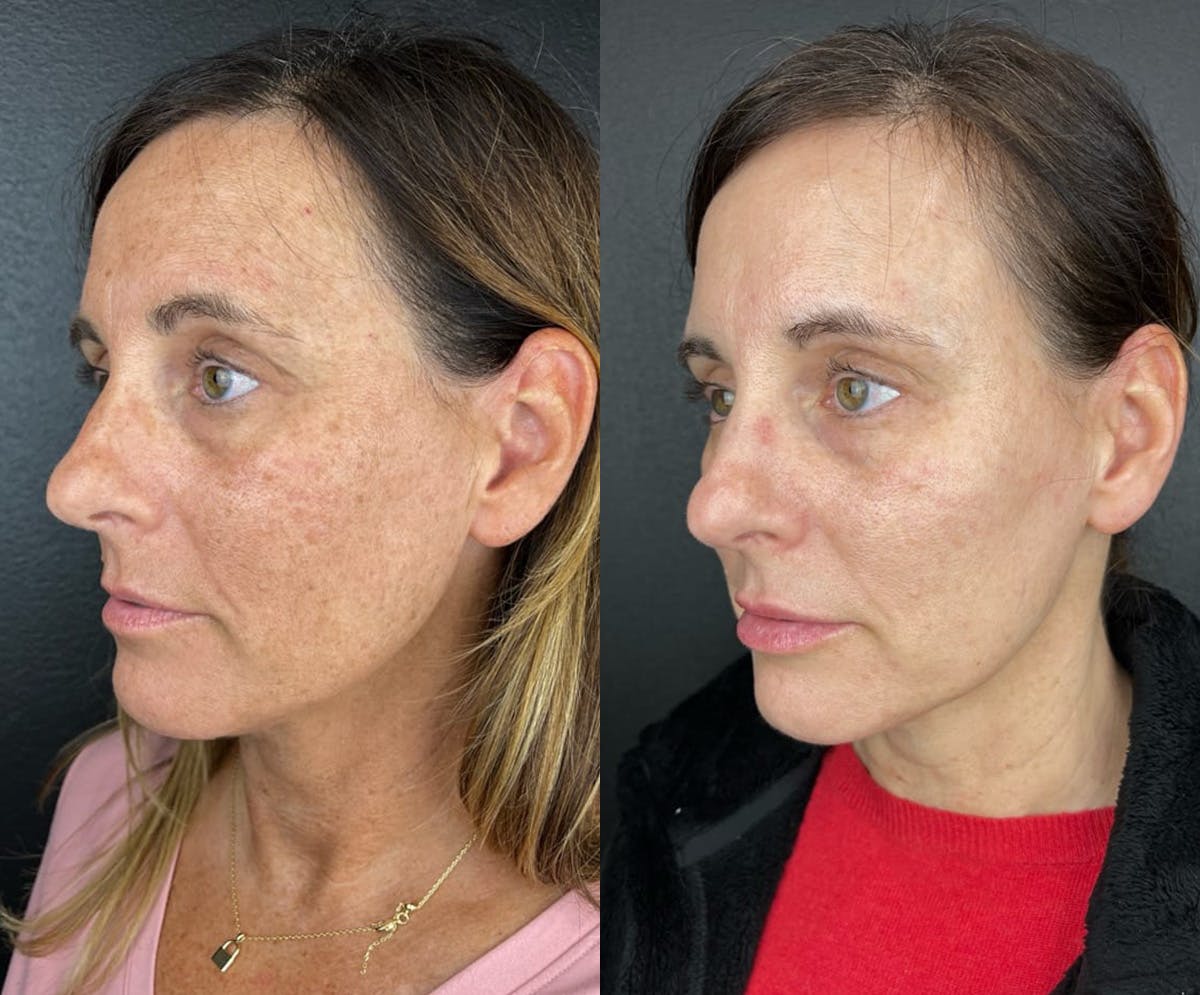 IPL Before & After Gallery - Patient 104796 - Image 1