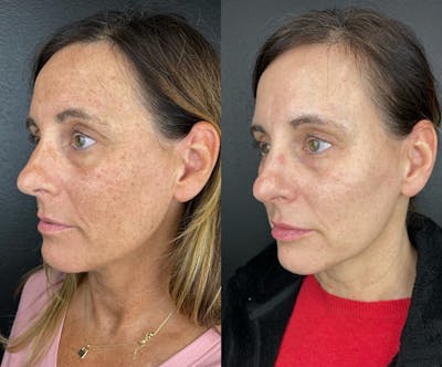 IPL Before & After Gallery - Patient 104796 - Image 1