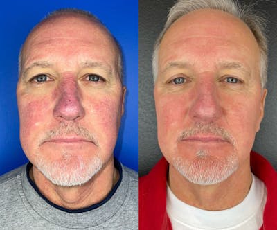 IPL Before & After Gallery - Patient 137235 - Image 1