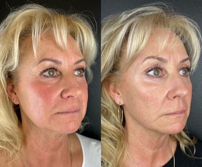 IPL Before & After Gallery - Patient 122314 - Image 1