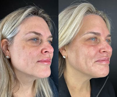 IPL Before & After Gallery - Patient 398682 - Image 1
