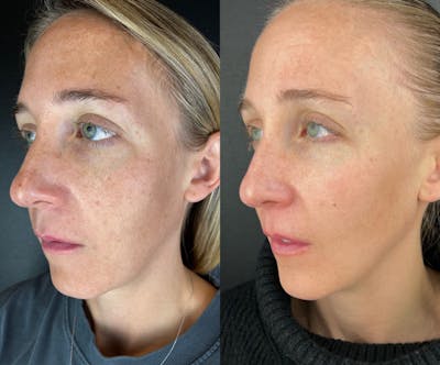 IPL Before & After Gallery - Patient 117629 - Image 1