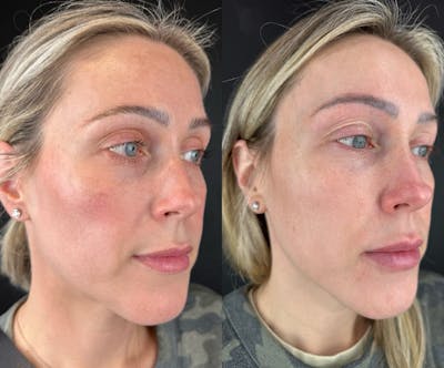 IPL Before & After Gallery - Patient 366034 - Image 1