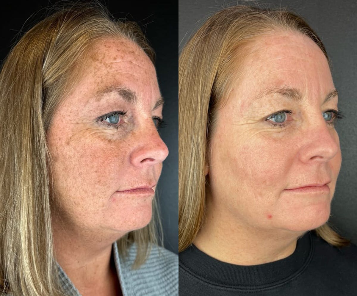 IPL Before & After Gallery - Patient 413800 - Image 1