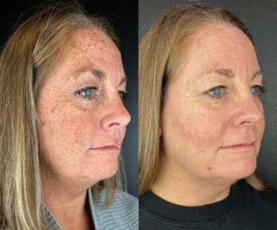 IPL Before & After Gallery - Patient 413800 - Image 1