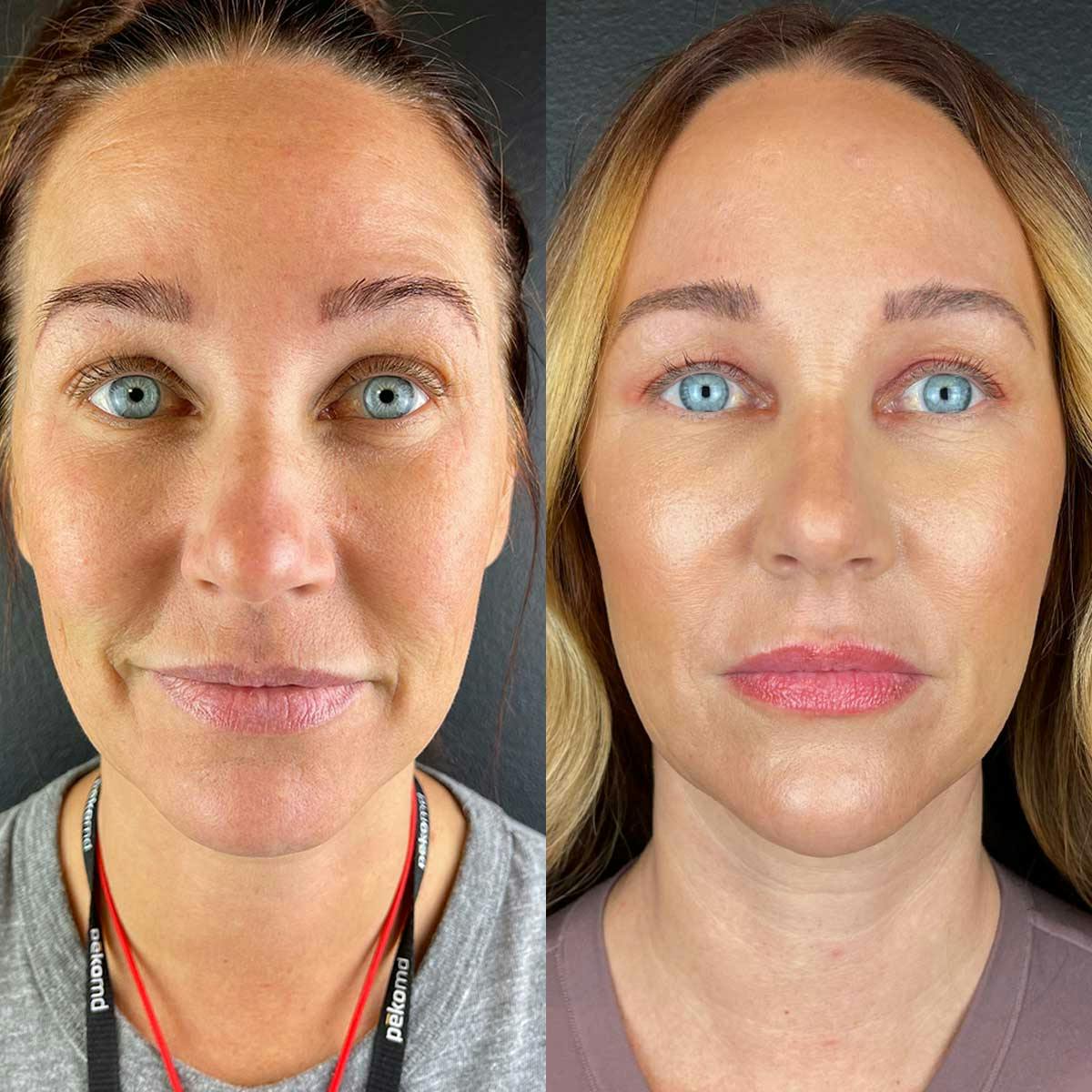 Chin filler treatment results