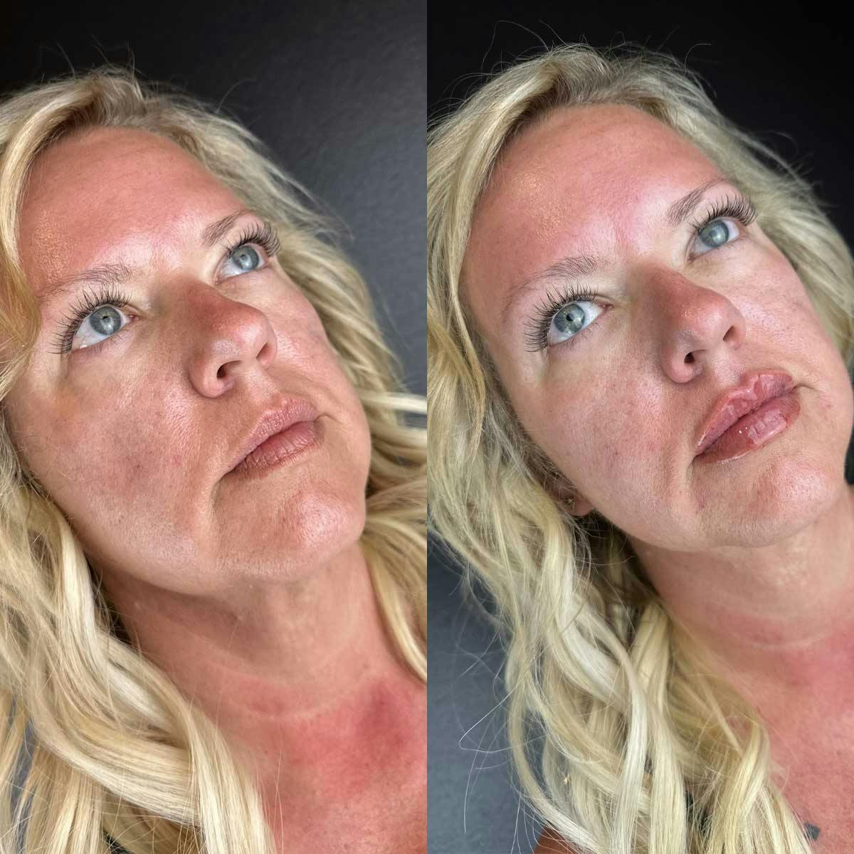 Lip filler treatment results