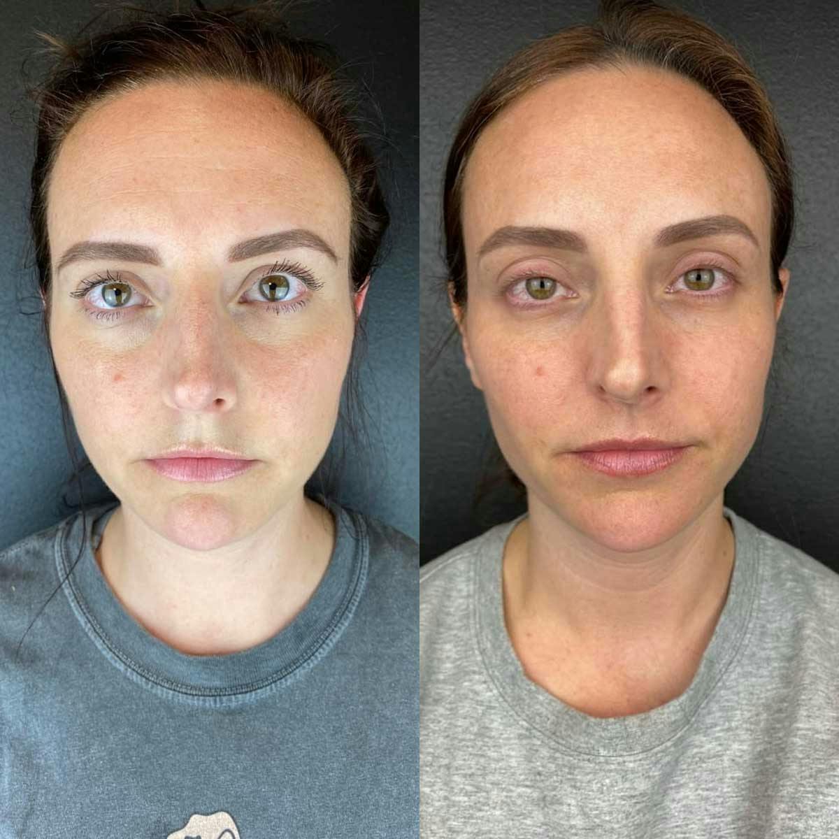 RF microneedling treatment results