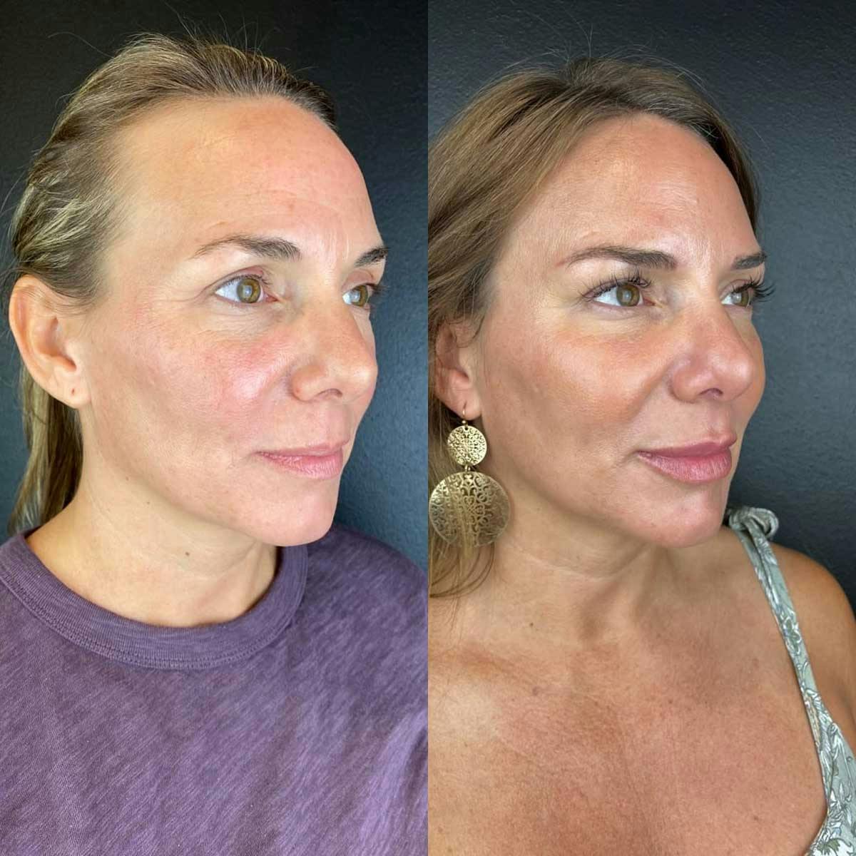 Sculptra treatment results