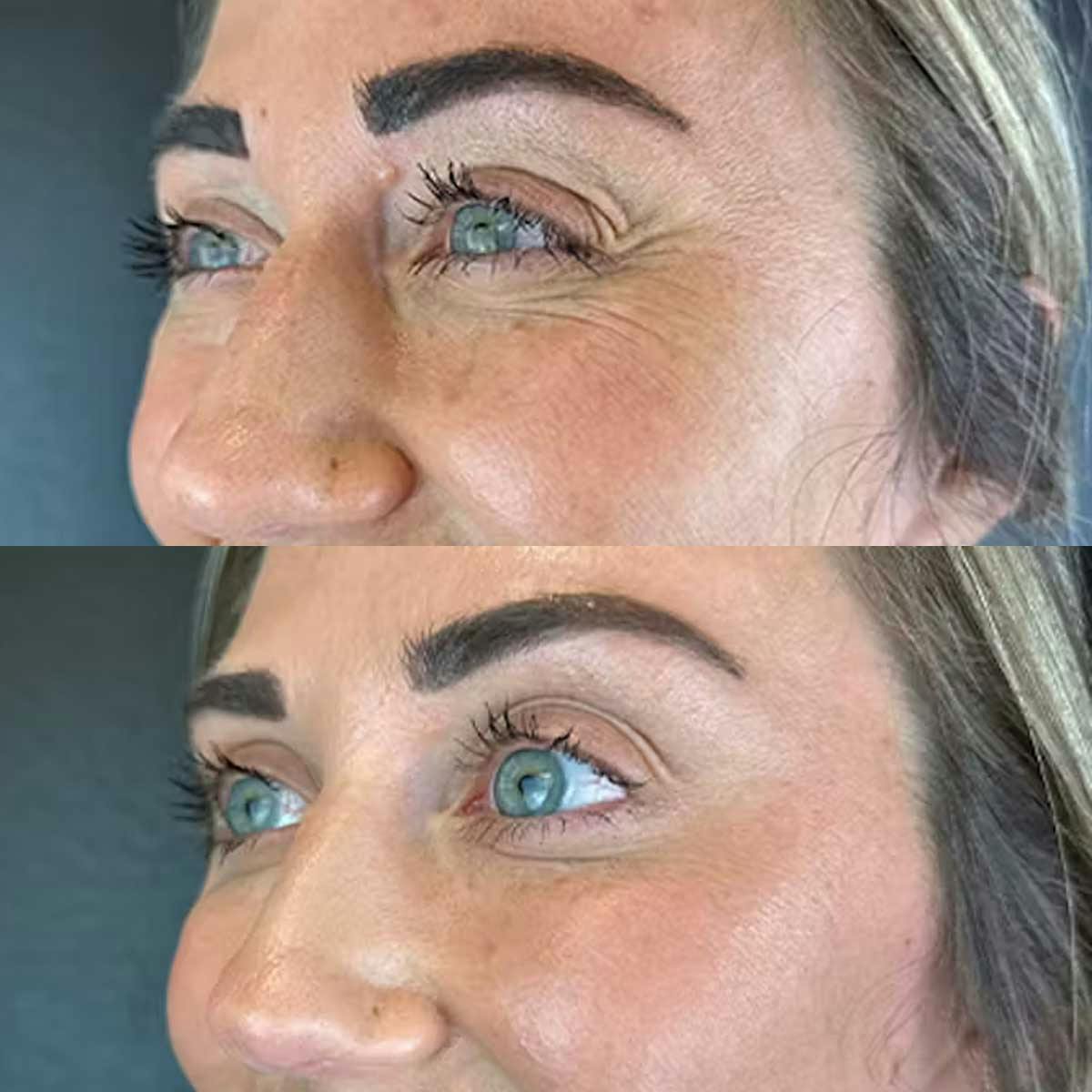 Wrinkle relaxer treatment results