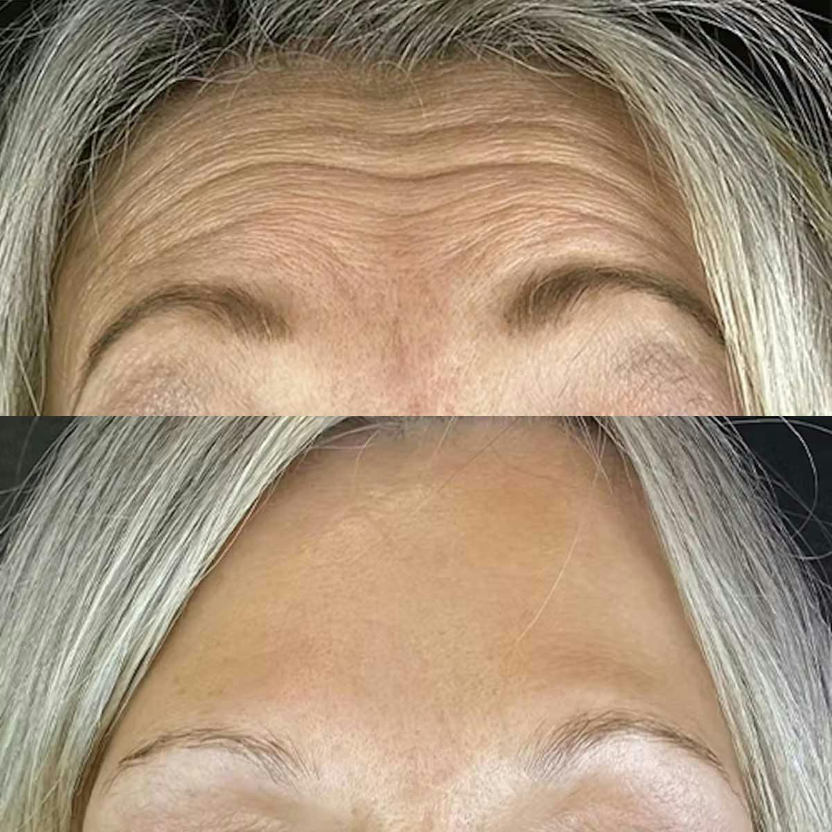 Wrinkle relaxer treatment results