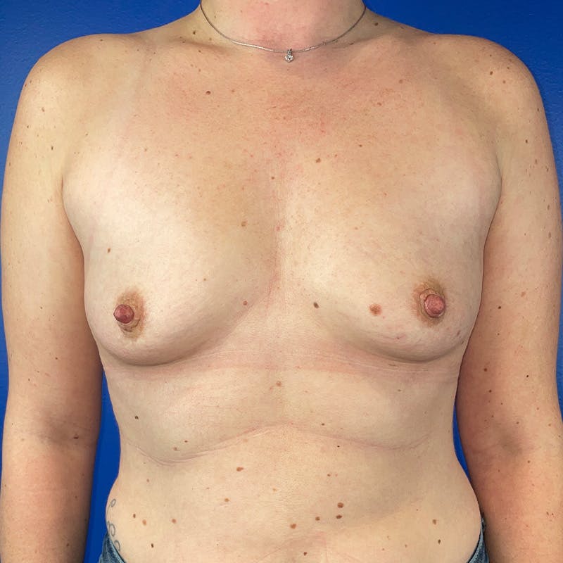 Breast Augmentation Before & After Gallery - Patient 161801 - Image 1