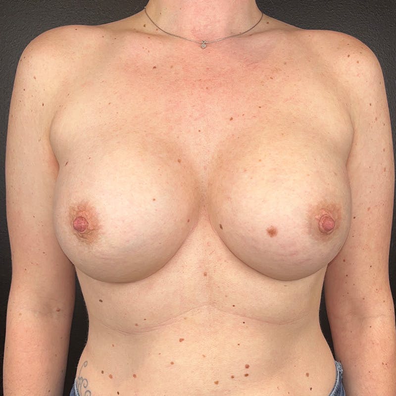 Breast Augmentation Before & After Gallery - Patient 161801 - Image 2
