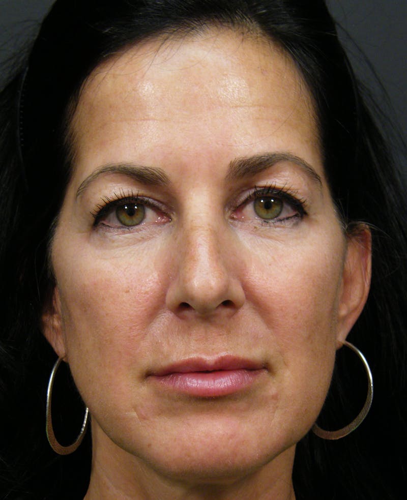 Cosmetic Surgeries Before & After Gallery - Patient 367785 - Image 1