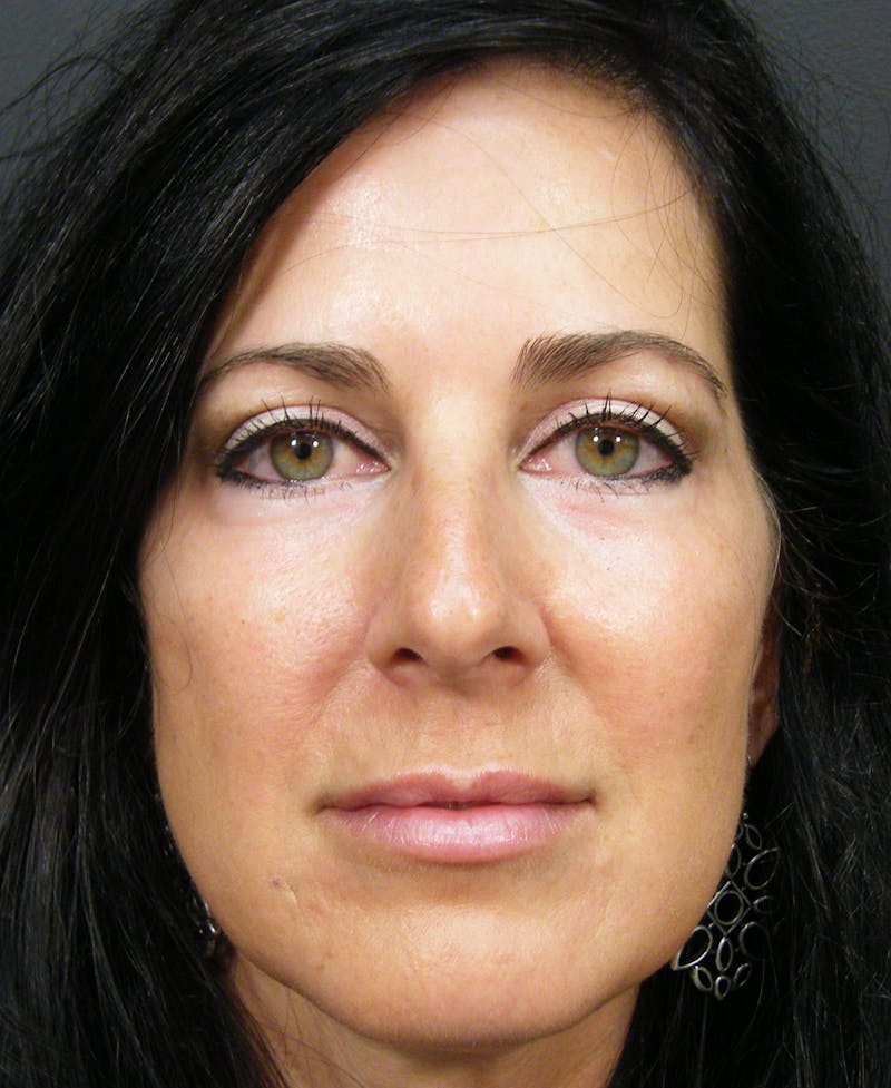 Cosmetic Surgeries Before & After Gallery - Patient 367785 - Image 2
