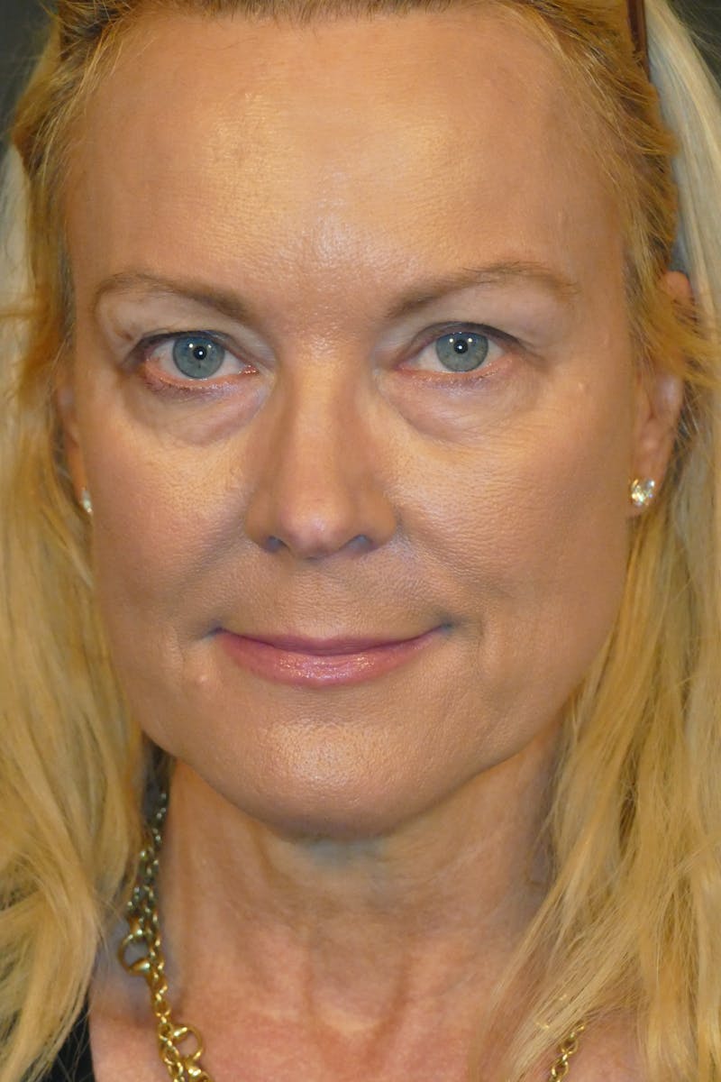 Cosmetic Surgeries Before & After Gallery - Patient 104455 - Image 1