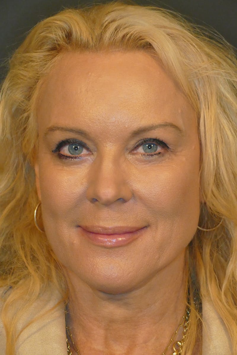 Cosmetic Surgeries Before & After Gallery - Patient 104455 - Image 2