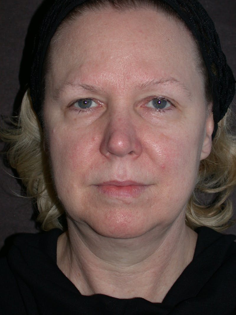 Cosmetic Surgeries Before & After Gallery - Patient 108235 - Image 1
