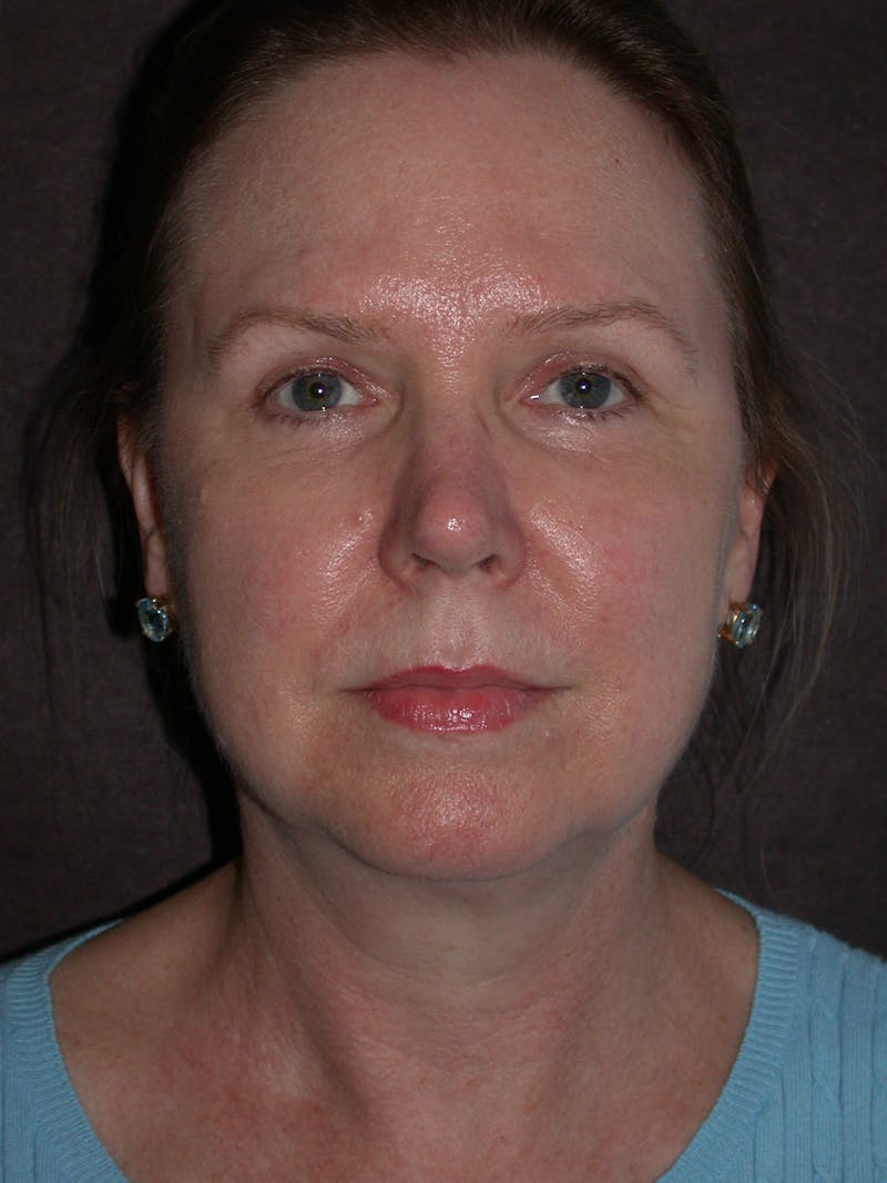 Cosmetic Surgeries Before & After Gallery - Patient 108235 - Image 2