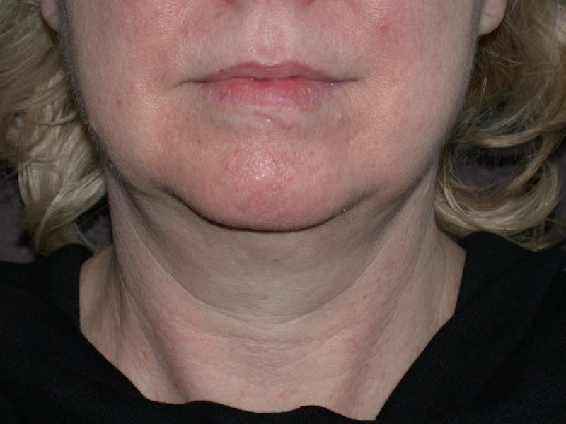 Cosmetic Surgeries Before & After Gallery - Patient 108235 - Image 3