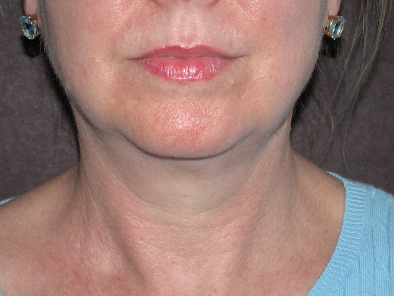 Cosmetic Surgeries Before & After Gallery - Patient 108235 - Image 4
