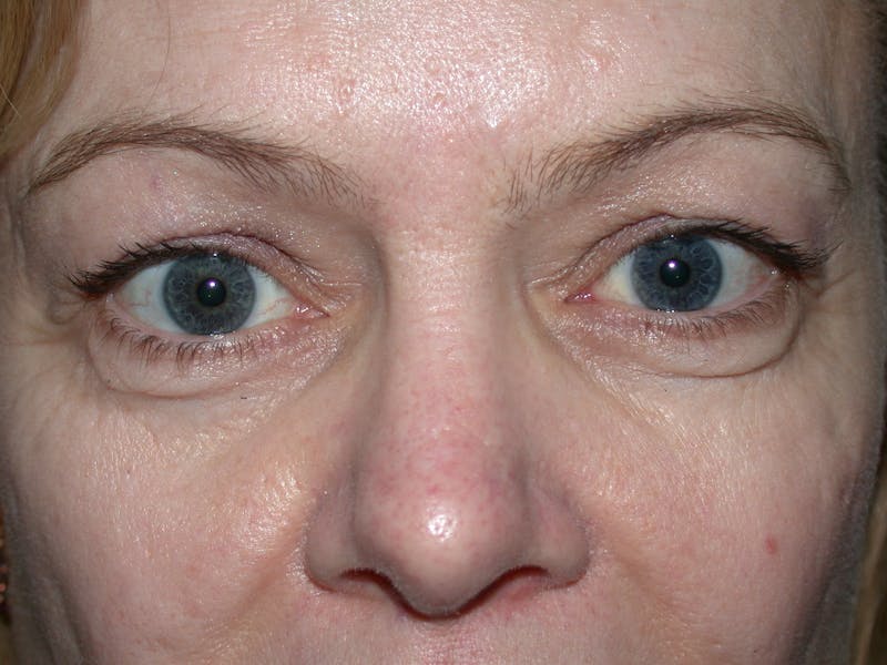 Cosmetic Surgeries Before & After Gallery - Patient 167778 - Image 1