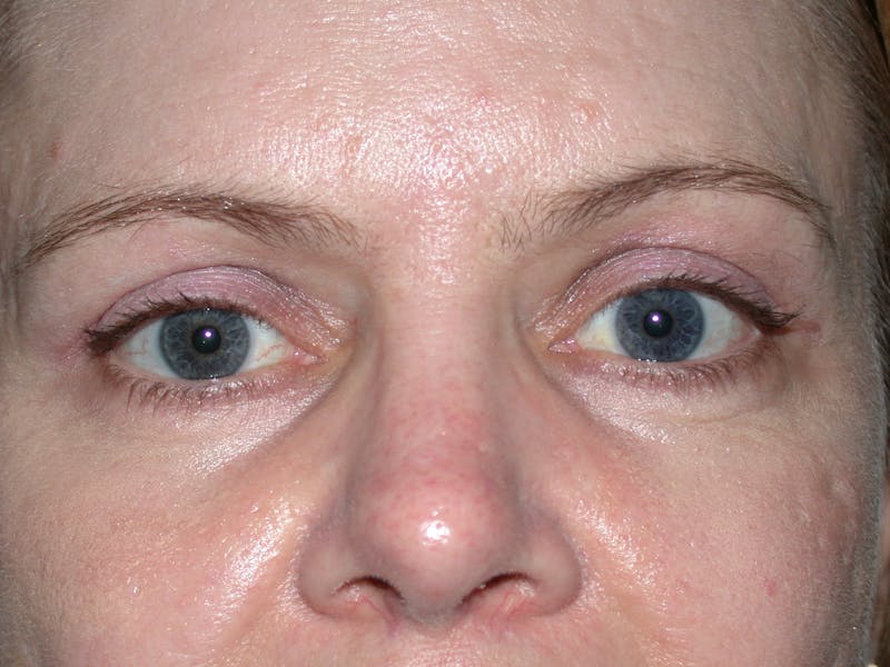Cosmetic Surgeries Before & After Gallery - Patient 167778 - Image 2
